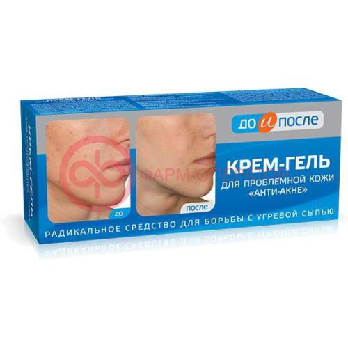 До и после крем-гель 50мл анти-акне д/пробл кожи